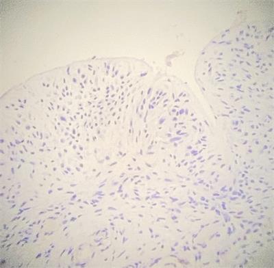 Case Report: Early Breast Cancer Recurrence Mimicking BIA-ALCL in a Patient With Multiple Breast Procedures